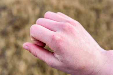 Dry Skin From Low Humidity In York, PA